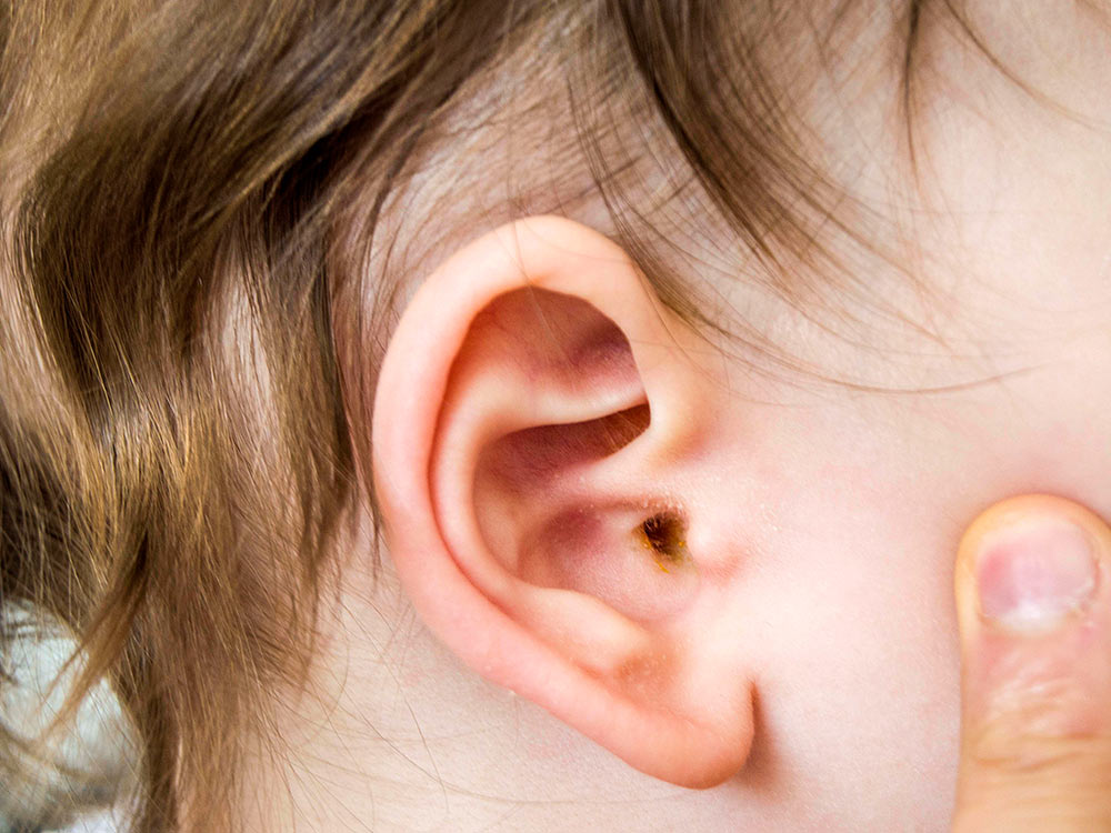 انواع بیماری های گوش و علل آن